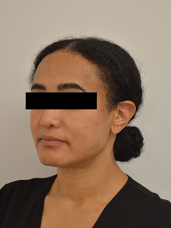 Hairline Lowering Before & After