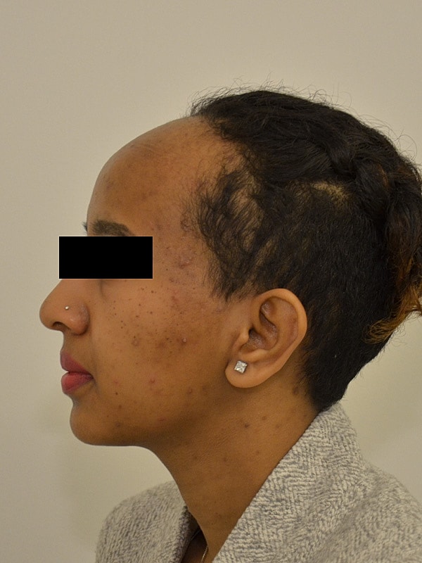 Hairline Lowering Before & After