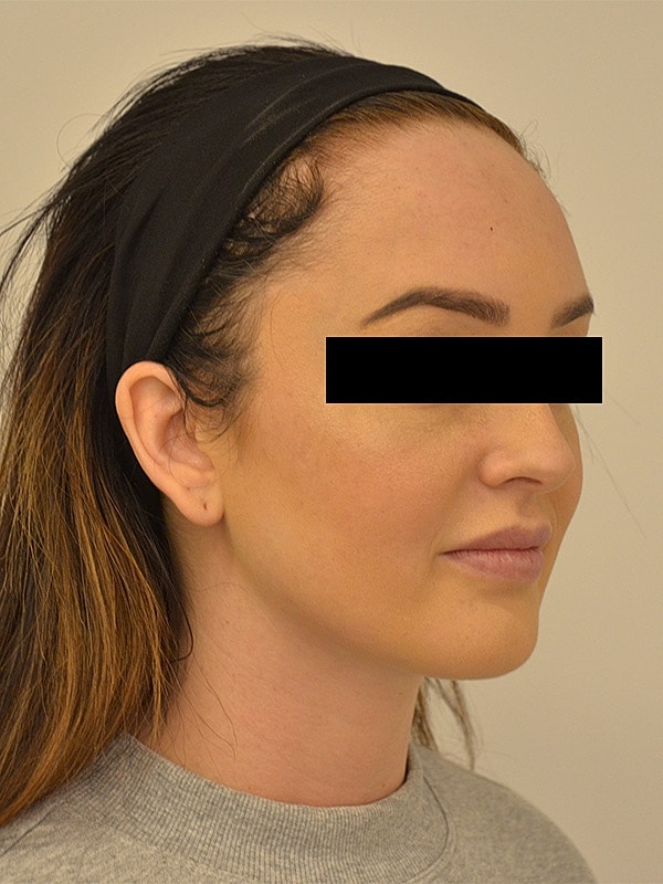 Hairline Lowering Before & After