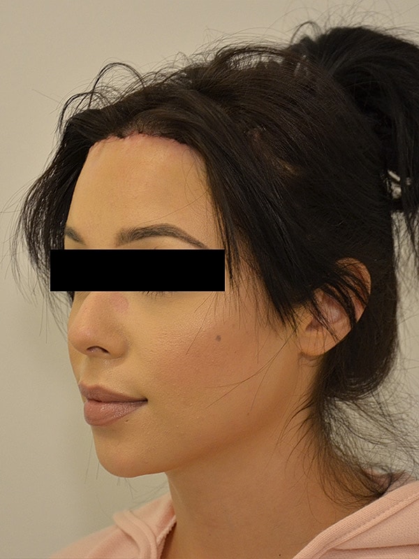 Hairline Lowering Before & After