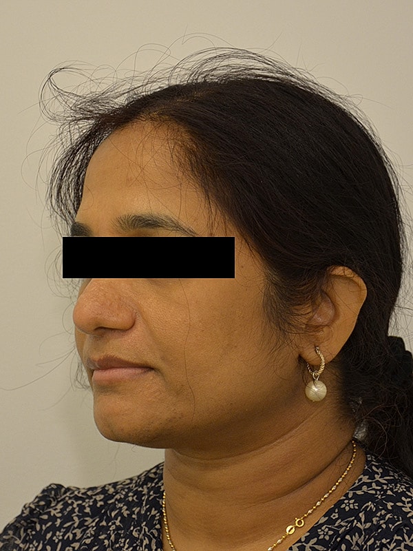 Hairline Lowering Before & After