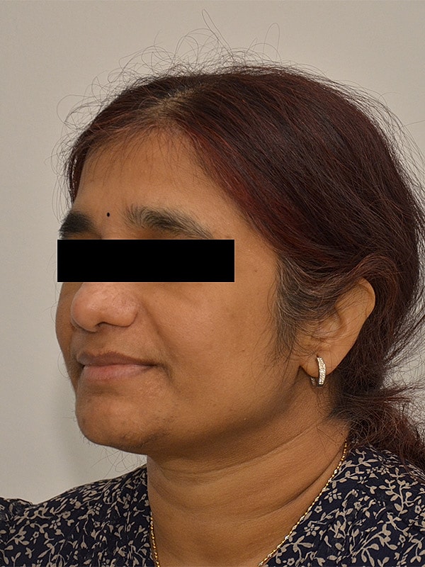 Hairline Lowering Before & After