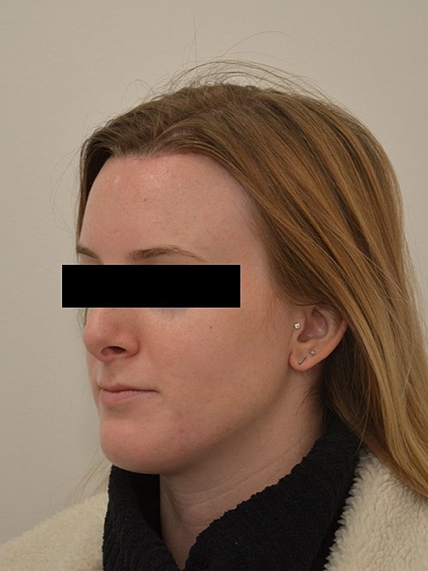 Hairline Lowering Before & After