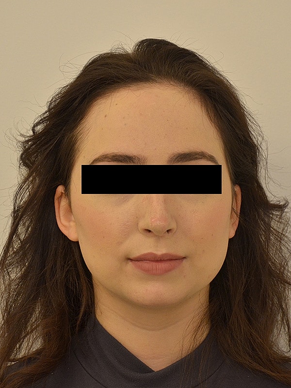 Hairline Lowering Before & After