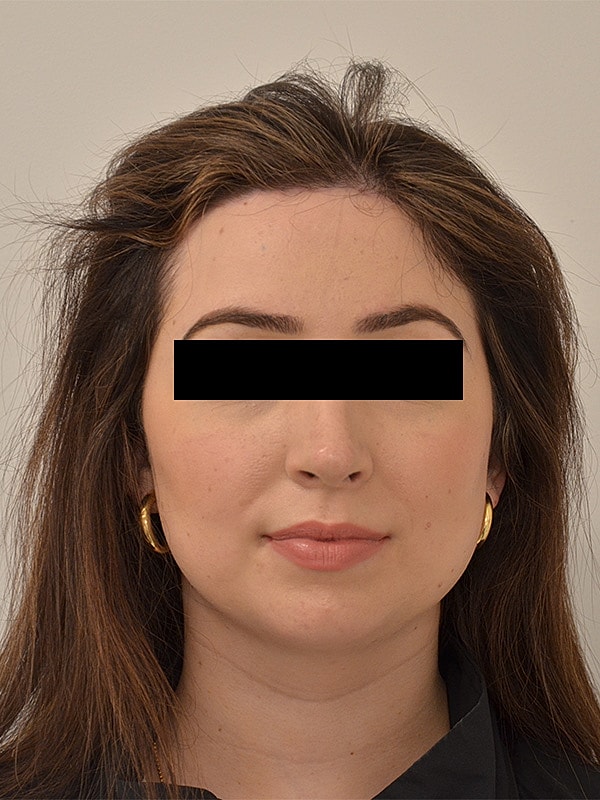 Hairline Lowering Before & After