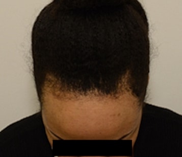 Hairline Lowering Before & After