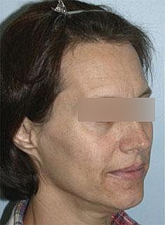 Hairline Lowering Before & After