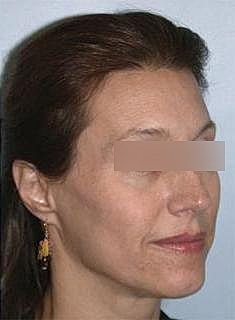 Hairline Lowering Before & After