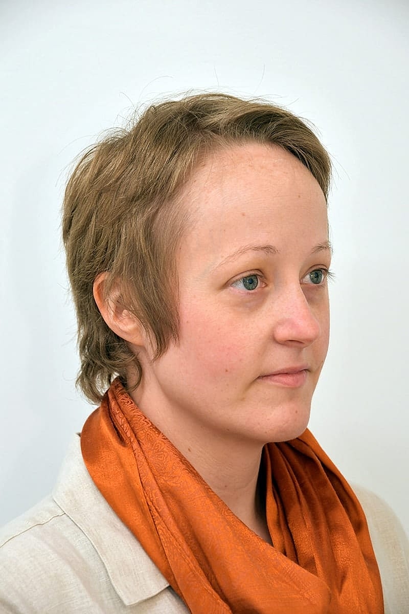 Hairline Lowering Before & After