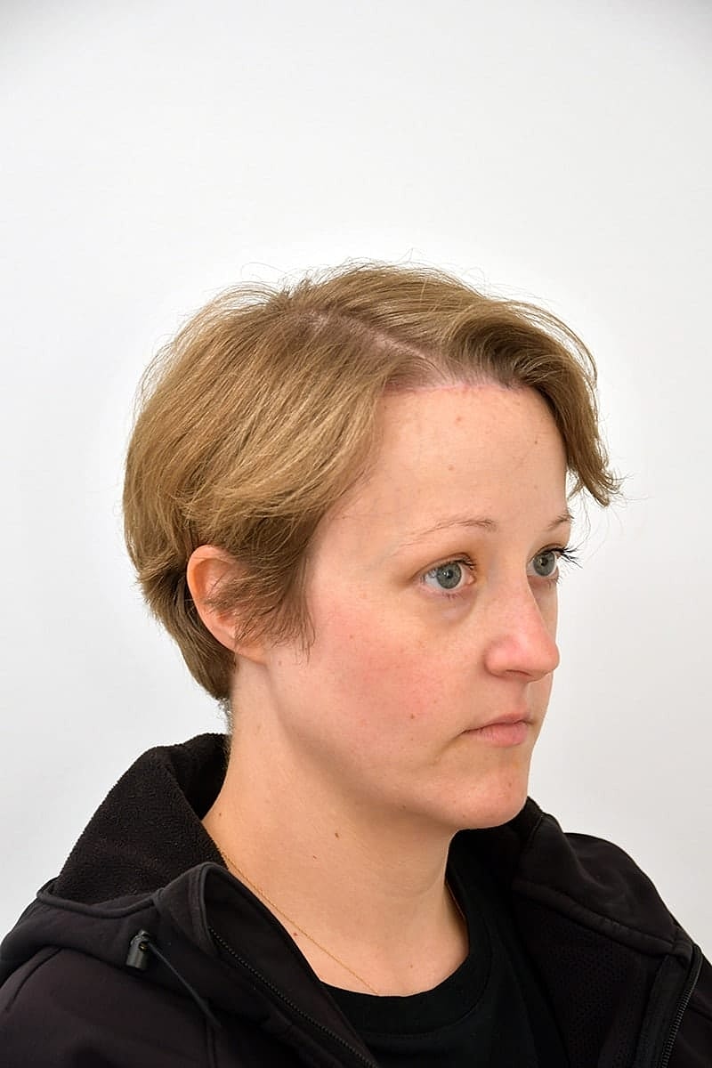 Hairline Lowering Before & After