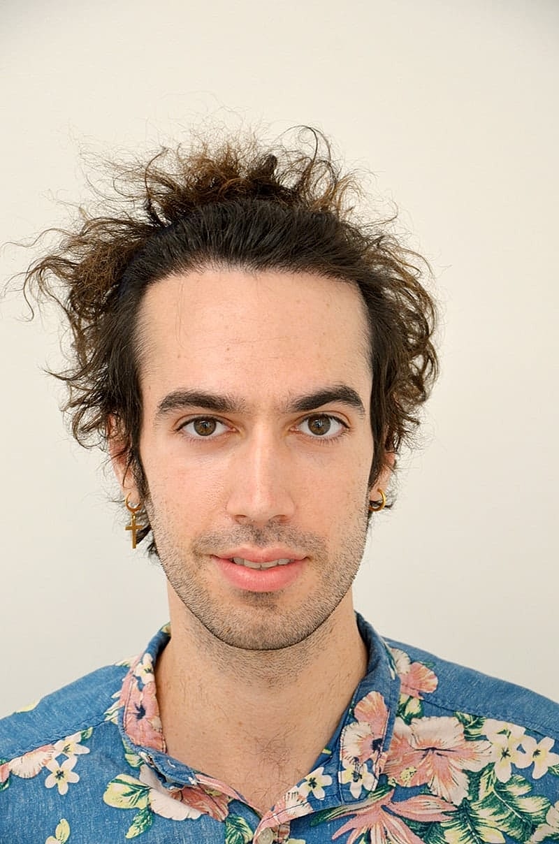 Hairline Lowering Before & After