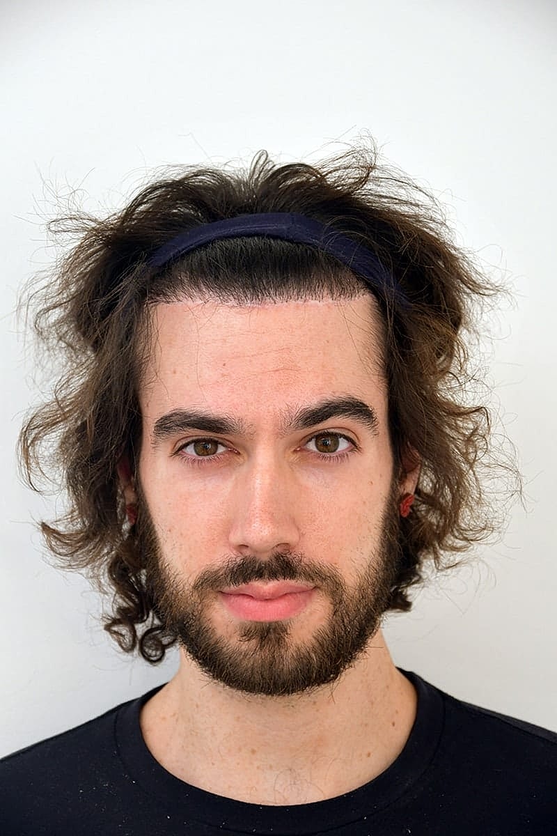 Hairline Lowering Before & After