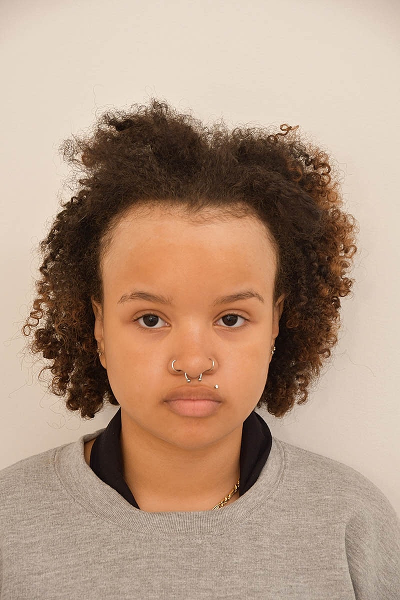 Hairline Lowering Before & After