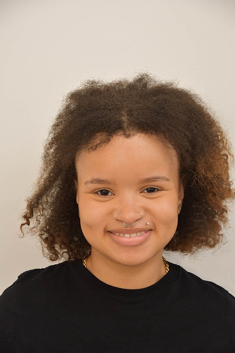 Hairline Lowering Before & After