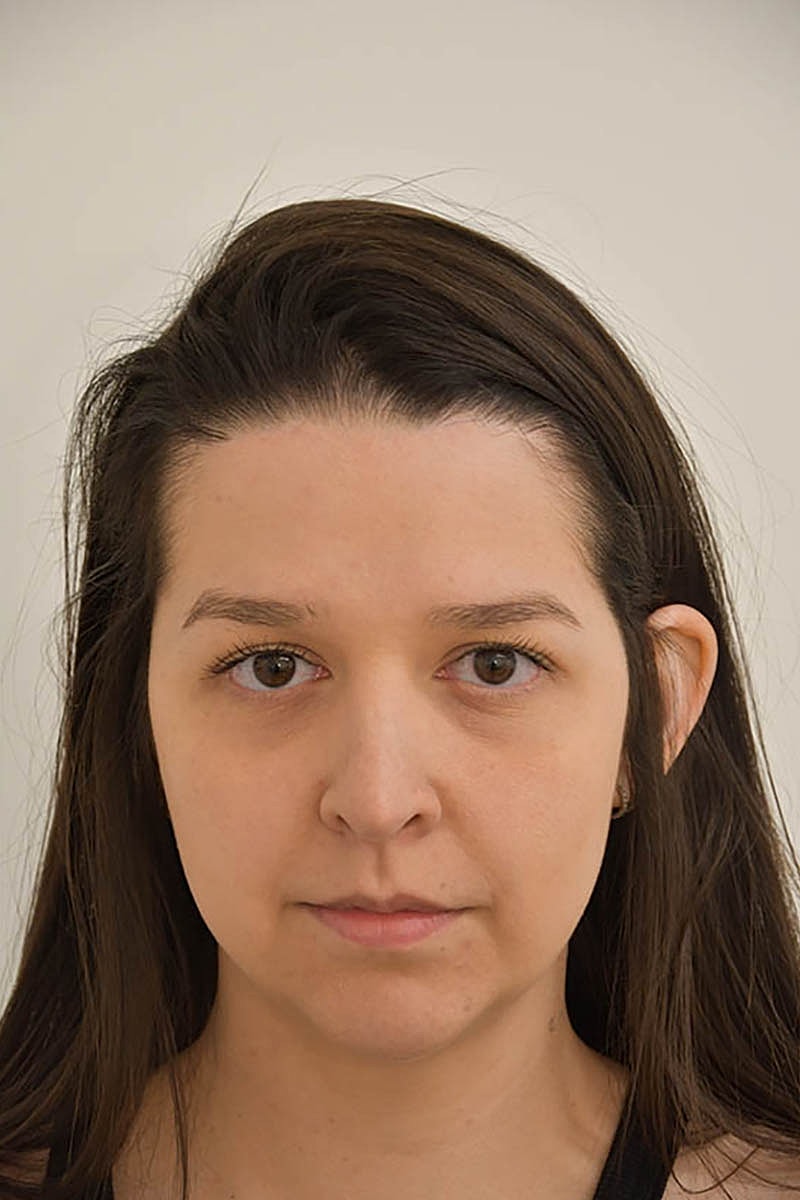 Hairline Lowering Before & After