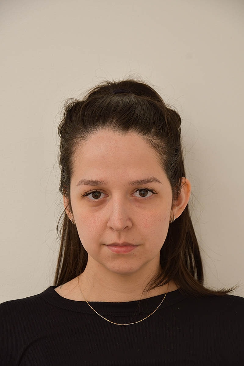 Hairline Lowering Before & After