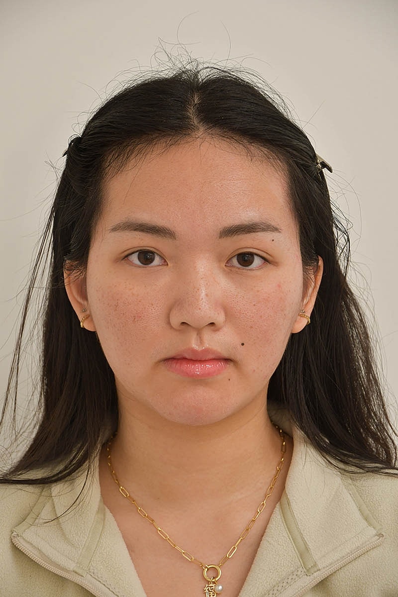 Hairline Lowering Before & After