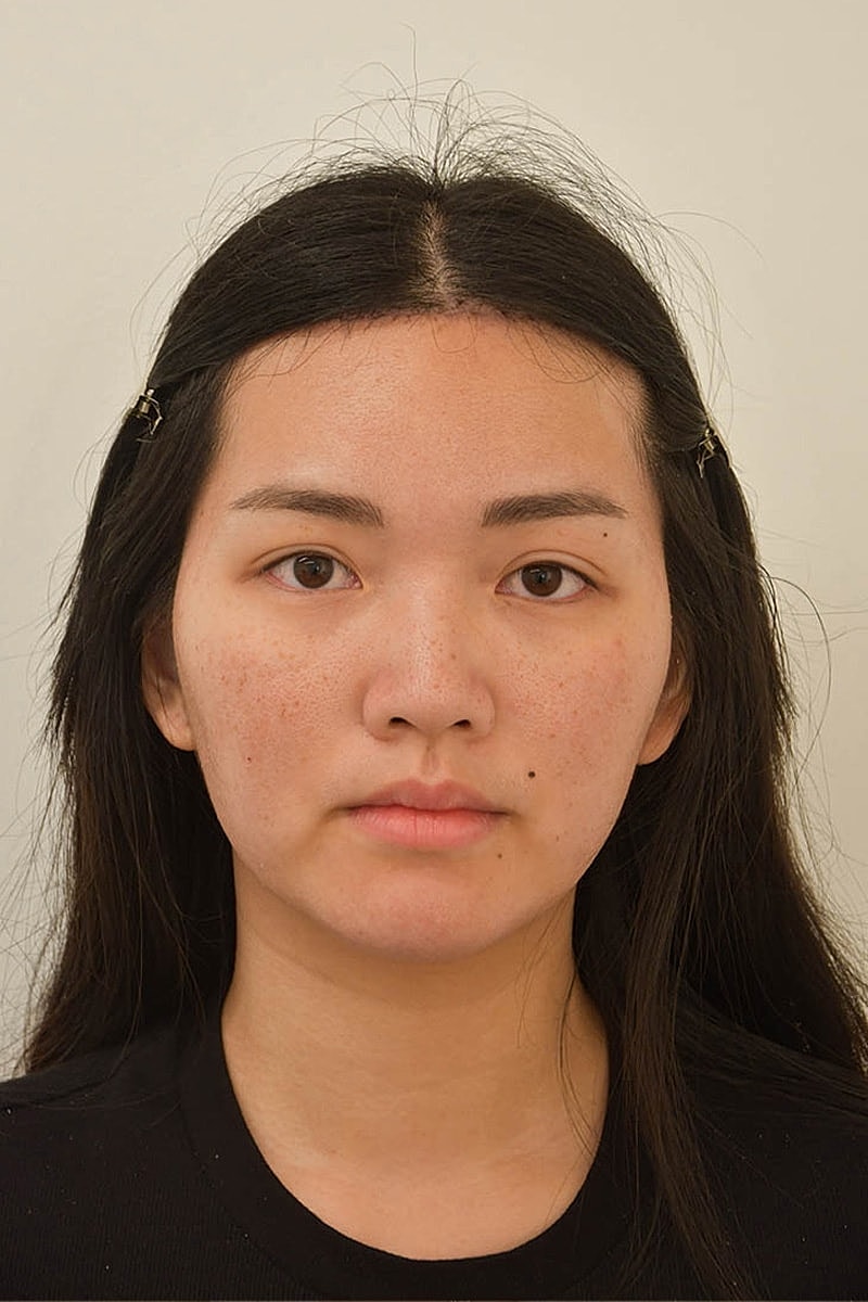 Hairline Lowering Before & After