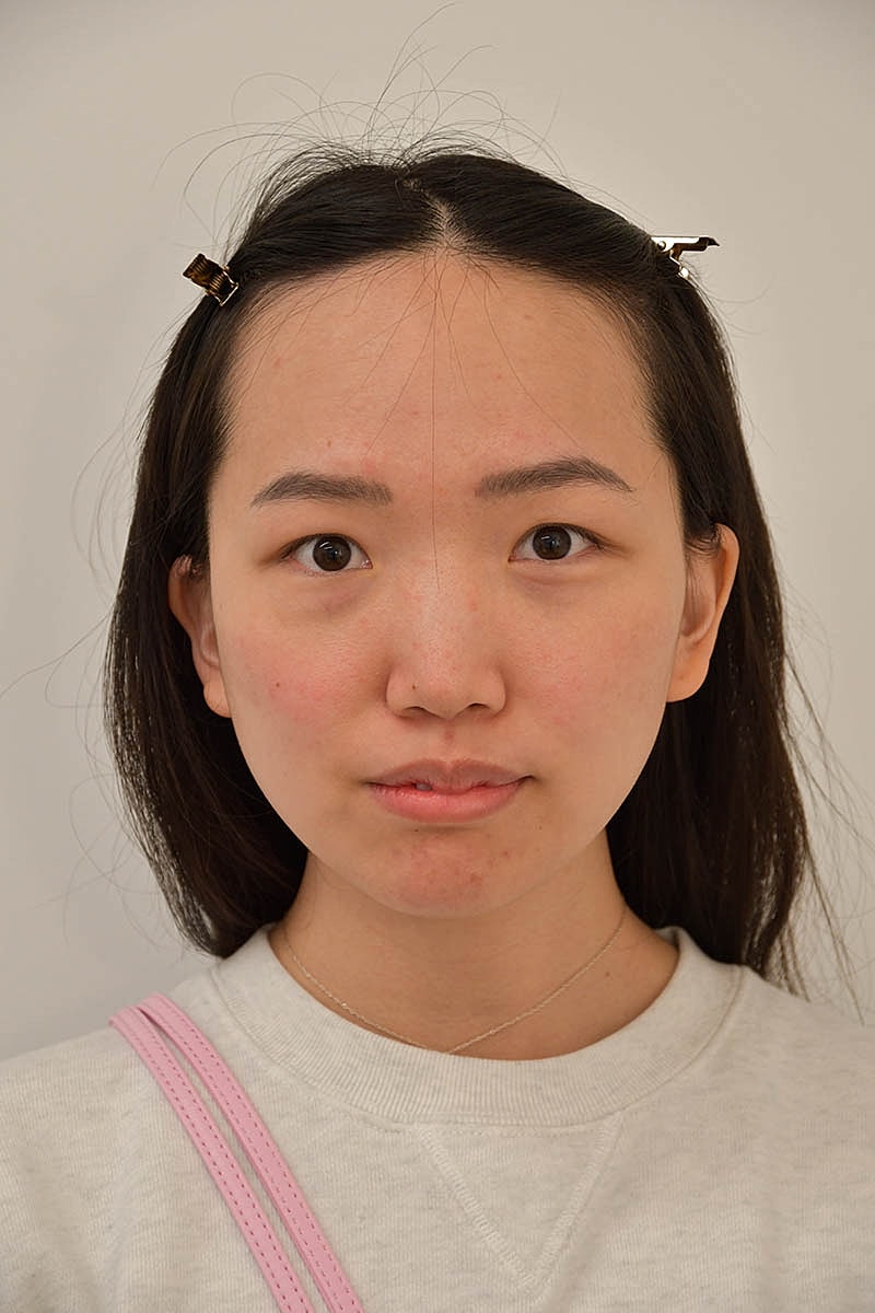 Hairline Lowering Before & After