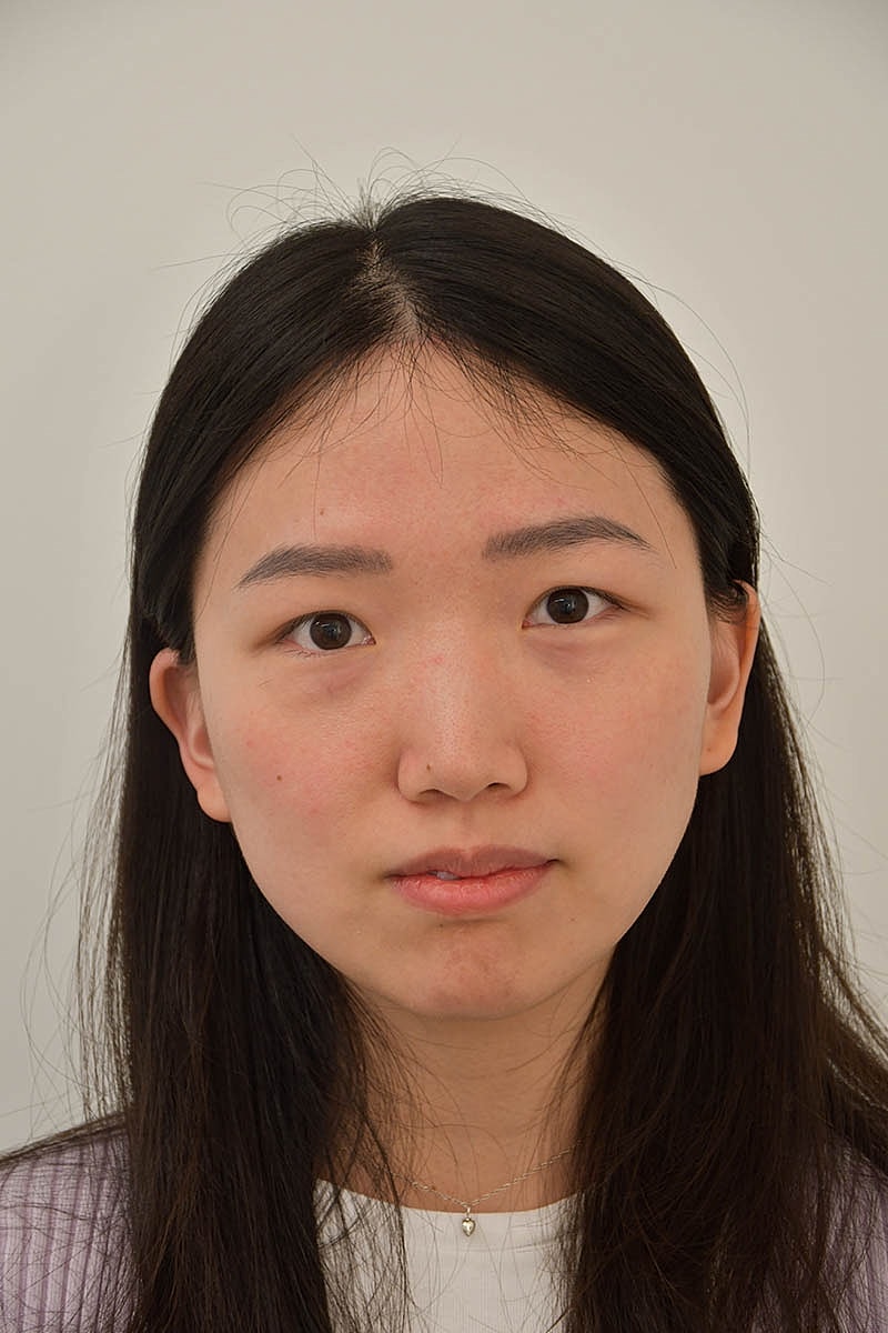 Hairline Lowering Before & After