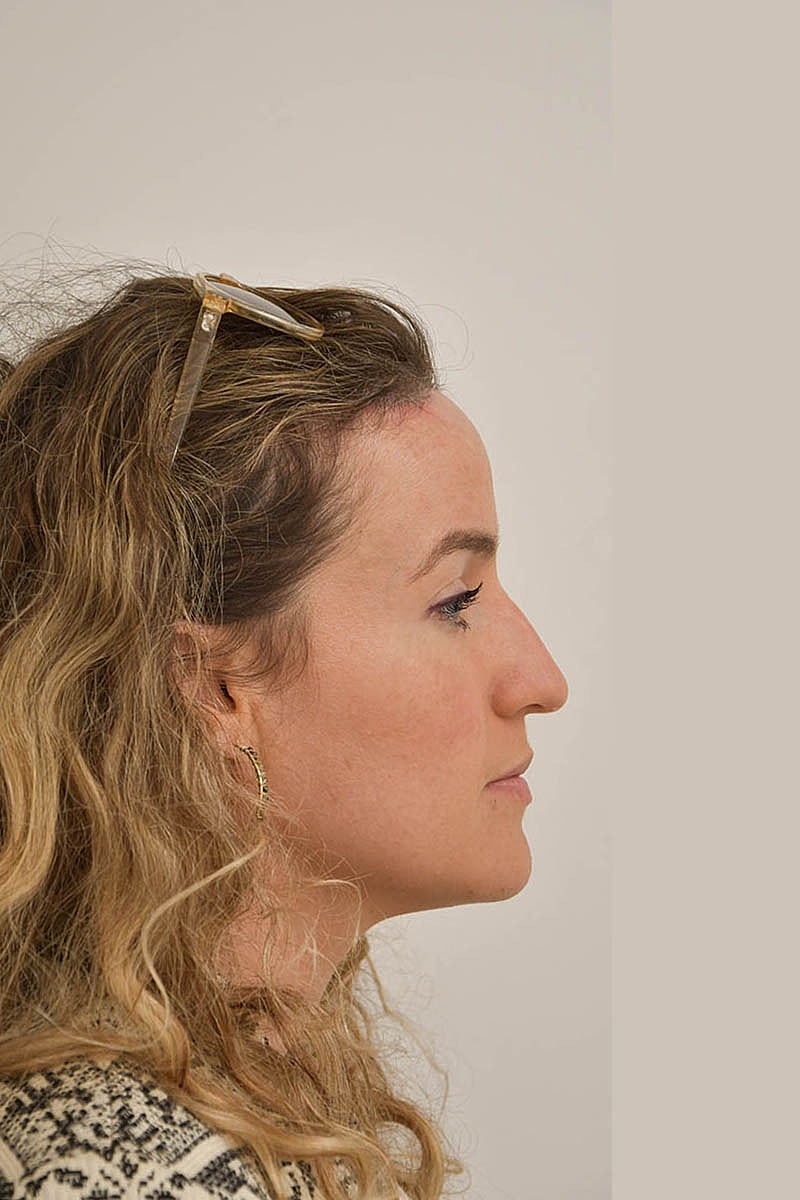 Hairline Lowering Before & After