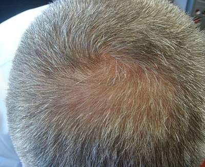 Neolts Led Light Therapy Before & After