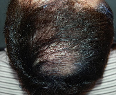 Neolts Led Light Therapy Before & After