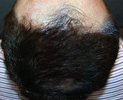 Neolts Led Light Therapy Before & After