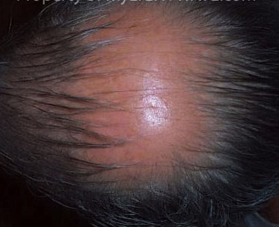 Neolts Led Light Therapy Before & After