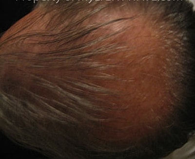 Neolts Led Light Therapy Before & After