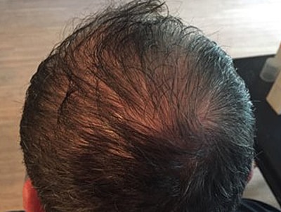 Prp For Hair Loss Before & After
