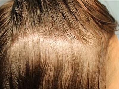 Prp For Hair Loss Before & After
