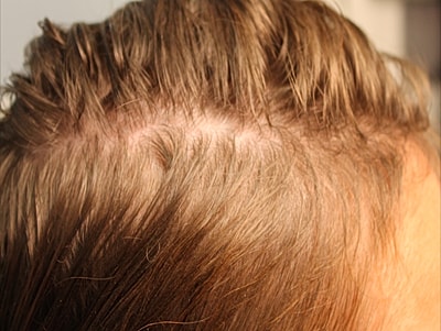 Prp For Hair Loss Before & After