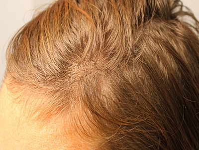 Prp For Hair Loss Before & After