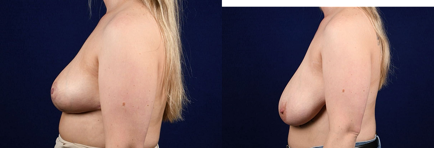 Breast Lift Reduction Before & After