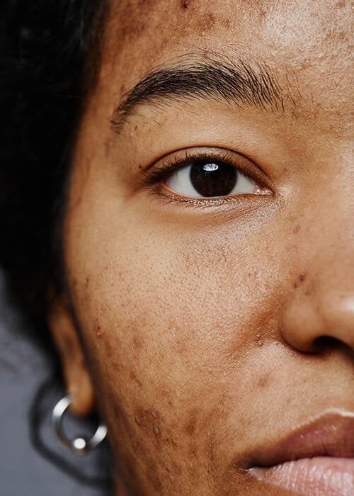 Acne Treatment in Nairobi