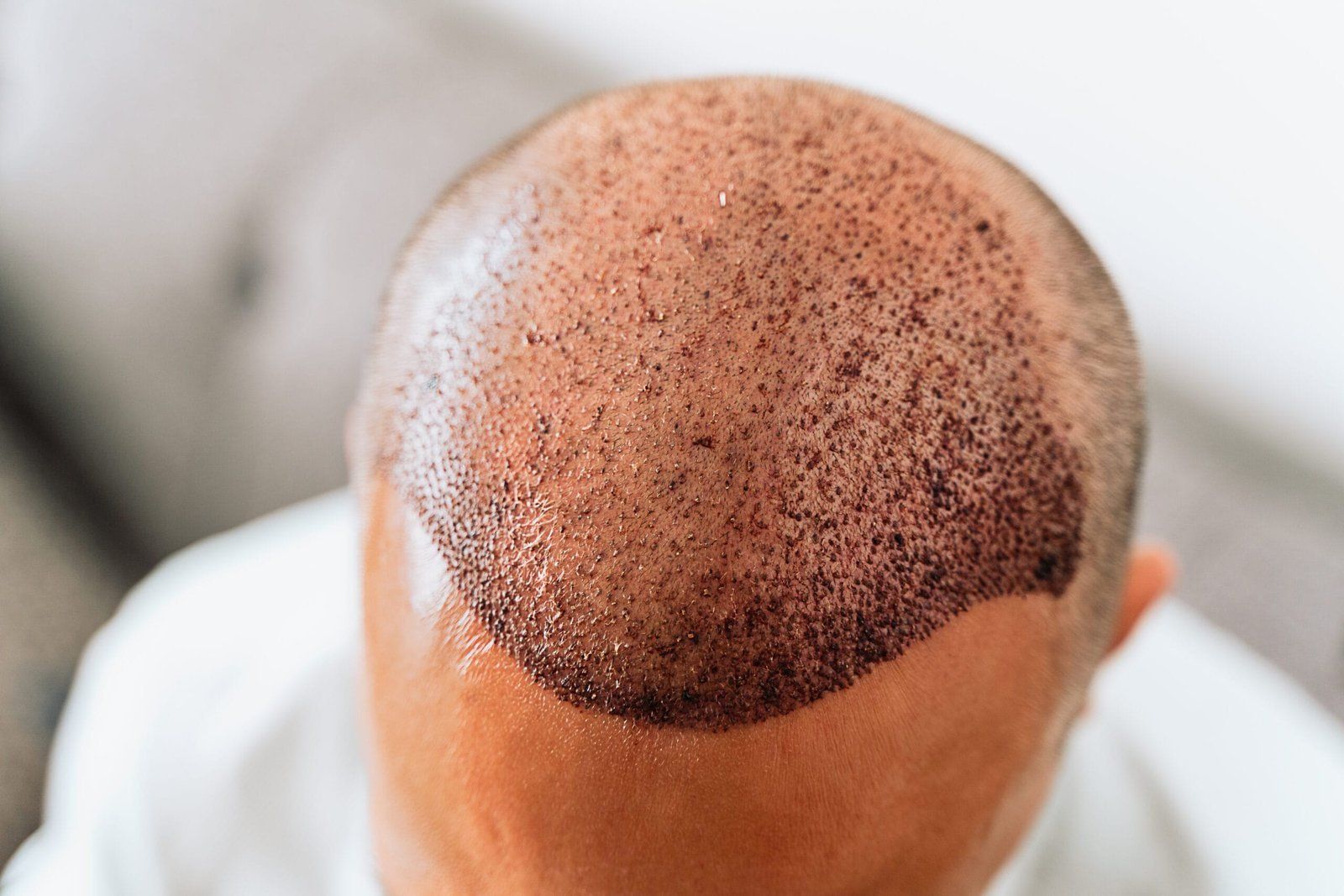 Best Countries to Get Hair Transplant