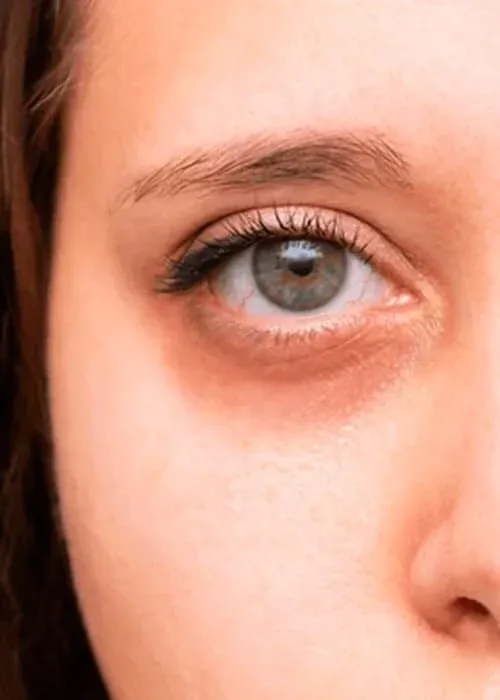 Blepharoplasty Treatment in Nairobi￼