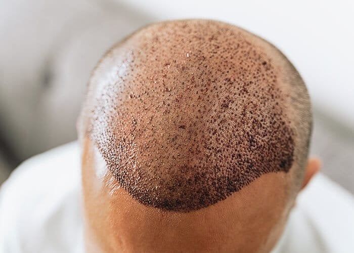 Scalp with hair restoration treatment visible.