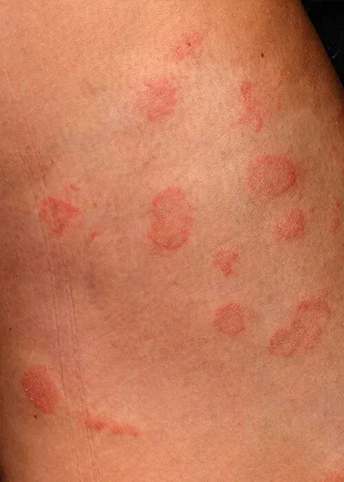 Skin Fungal Infection Treatment