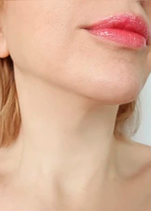 Thread Lifting Treatment in Nairobi