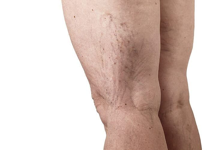 Varicose Veins Treatment in Nairobi